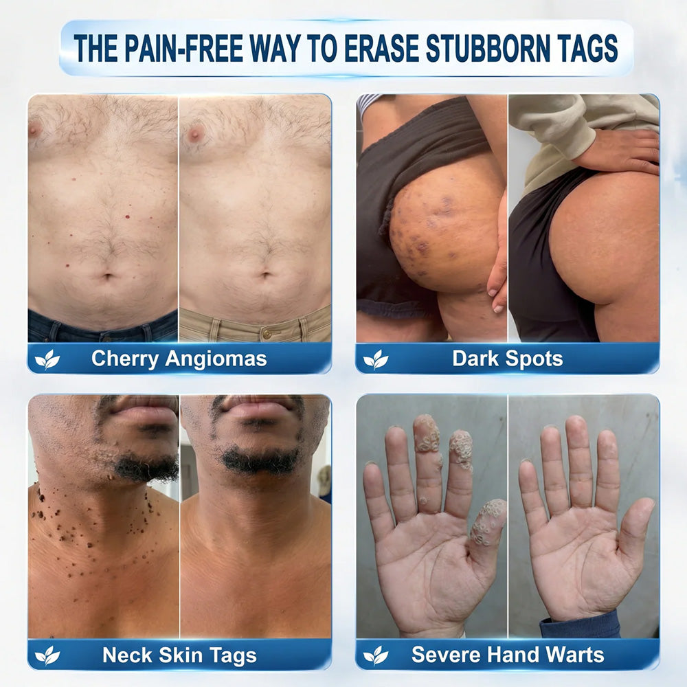 𝐏𝐡𝐚𝐫𝐦𝐚𝐜𝐢𝐬𝐭 𝐑𝐞𝐜𝐨𝐦𝐦𝐞𝐧𝐝𝐞𝐝🥇𝐏𝐮𝐫𝐞𝐥𝐨𝐫𝐚®7-𝐃𝐚𝐲 𝐒𝐤𝐢𝐧 𝐓𝐚𝐠 & 𝐒𝐩𝐨𝐭 𝐄𝐫𝐚𝐬𝐞𝐫 𝐂𝐫𝐞𝐚𝐦 🍀(Zero Pain, Zero 𝐒𝐜𝐚𝐫𝐬 Formula)