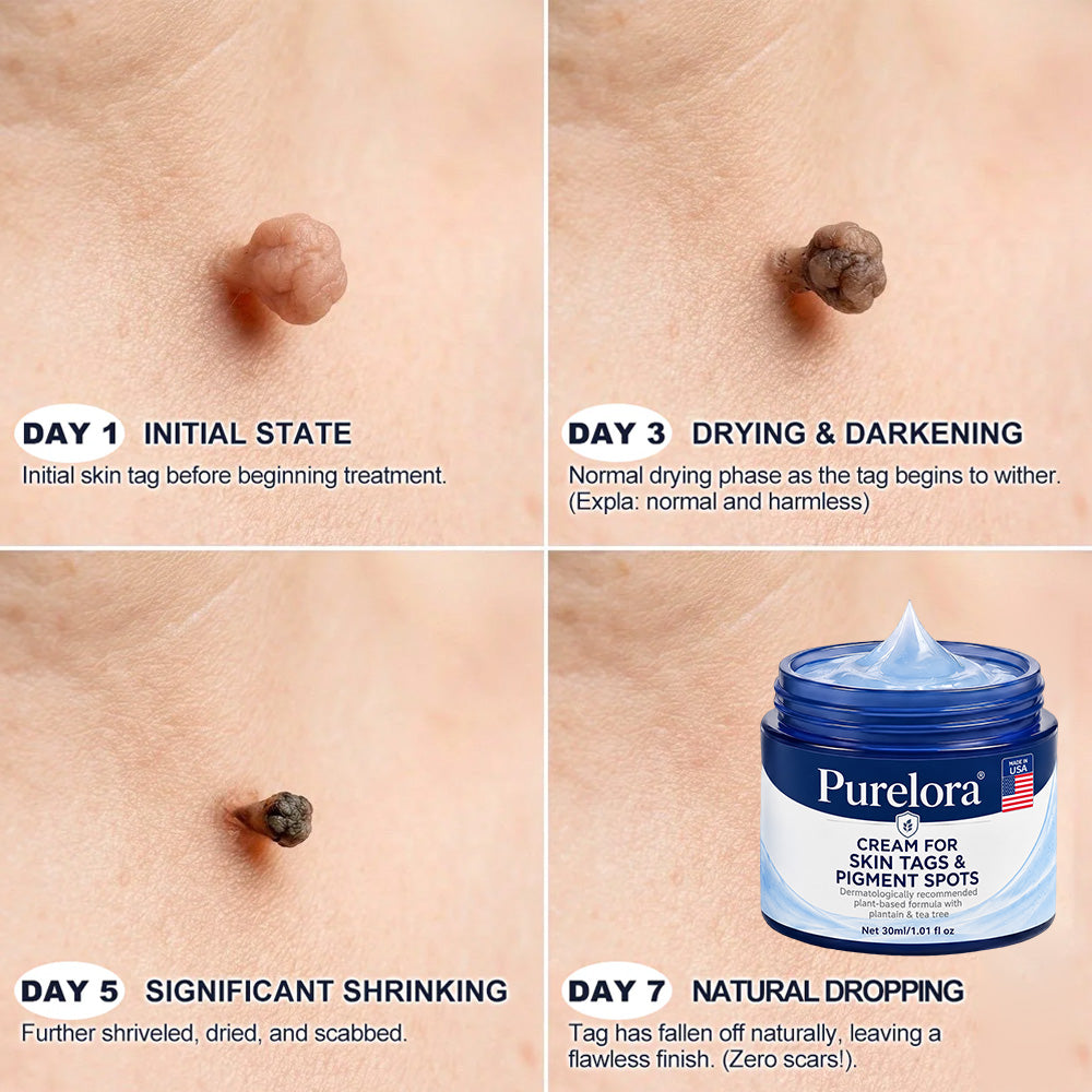 𝐏𝐡𝐚𝐫𝐦𝐚𝐜𝐢𝐬𝐭 𝐑𝐞𝐜𝐨𝐦𝐦𝐞𝐧𝐝𝐞𝐝🥇𝐏𝐮𝐫𝐞𝐥𝐨𝐫𝐚®7-𝐃𝐚𝐲 𝐒𝐤𝐢𝐧 𝐓𝐚𝐠 & 𝐒𝐩𝐨𝐭 𝐄𝐫𝐚𝐬𝐞𝐫 𝐂𝐫𝐞𝐚𝐦 🍀(Zero Pain, Zero 𝐒𝐜𝐚𝐫𝐬 Formula)