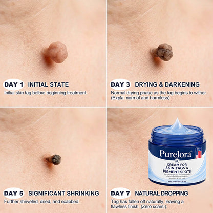 𝐏𝐡𝐚𝐫𝐦𝐚𝐜𝐢𝐬𝐭 𝐑𝐞𝐜𝐨𝐦𝐦𝐞𝐧𝐝𝐞𝐝🥇𝐏𝐮𝐫𝐞𝐥𝐨𝐫𝐚®7-𝐃𝐚𝐲 𝐒𝐤𝐢𝐧 𝐓𝐚𝐠 & 𝐒𝐩𝐨𝐭 𝐄𝐫𝐚𝐬𝐞𝐫 𝐂𝐫𝐞𝐚𝐦 🍀(Zero Pain, Zero 𝐒𝐜𝐚𝐫𝐬 Formula)